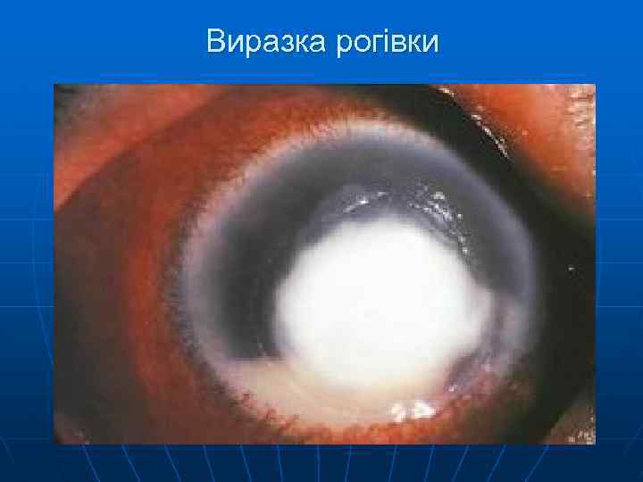 Виразка рогівки 