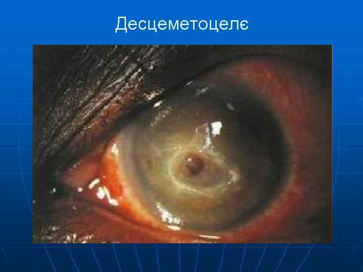 Десцеметоцелє 