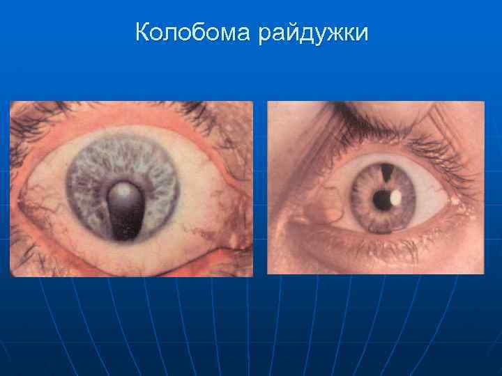 Колобома райдужки 