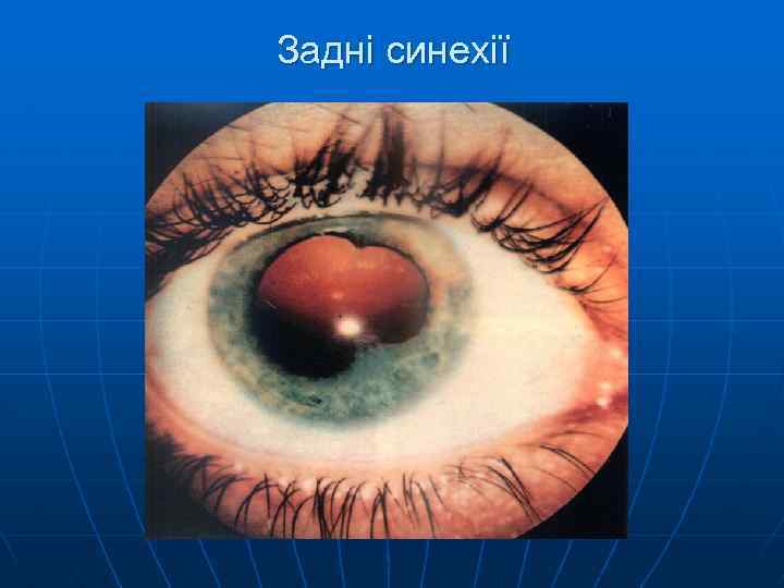 Задні синехії 