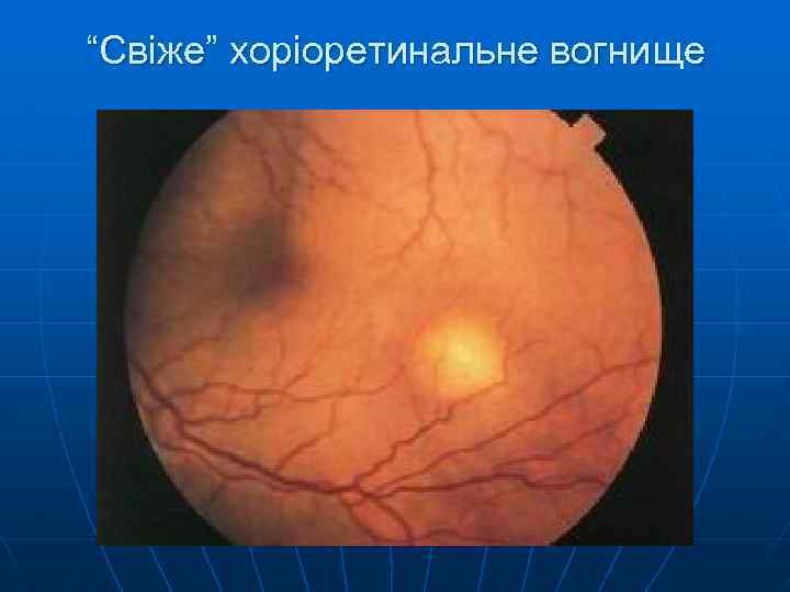 “Свіже” хоріоретинальне вогнище 