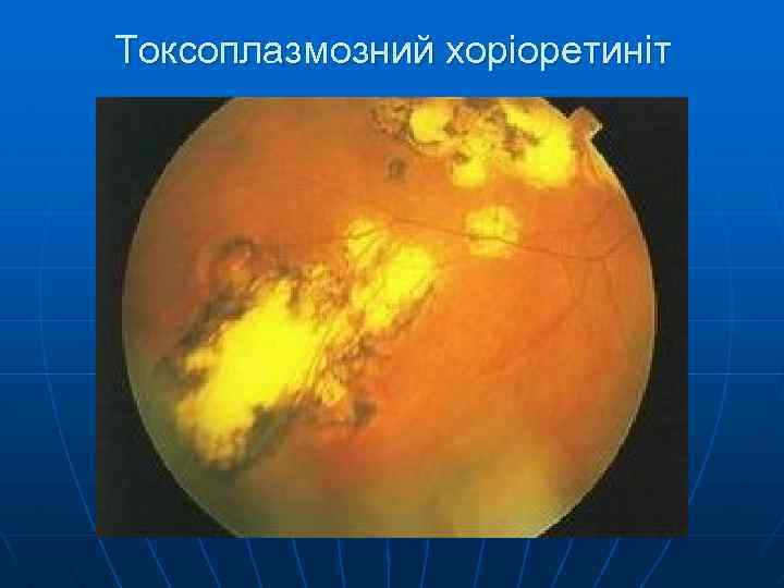 Токсоплазмозний хоріоретиніт 