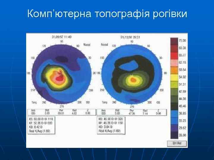 Комп’ютерна топографія рогівки 