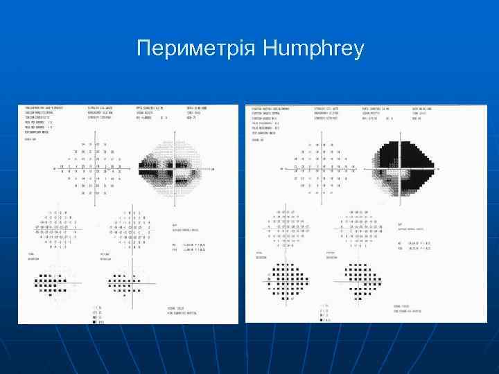 Периметрия в офтальмологии. Статическая периметрия норма. Периметрия Хамфри. Расшифровка компьютерной периметрии глаза. Статическая периметрия методика.