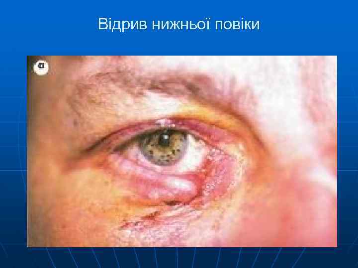 Відрив нижньої повіки 