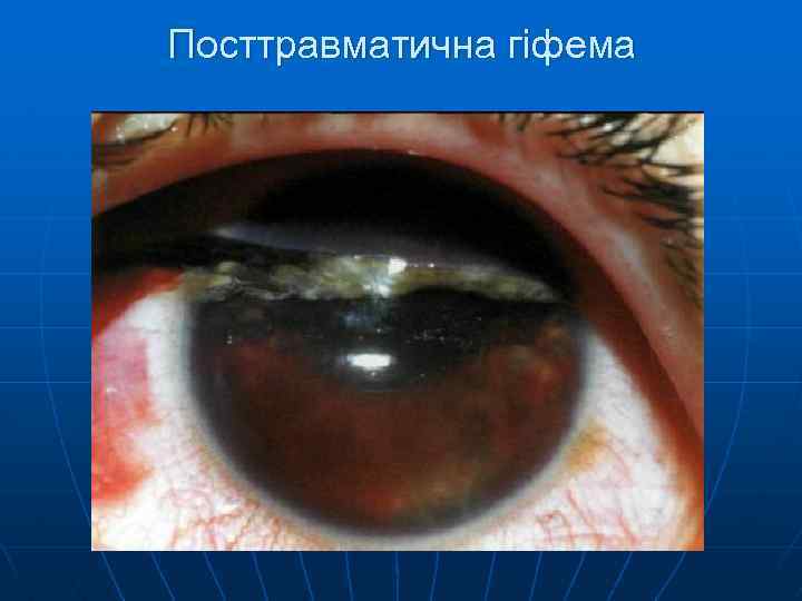 Посттравматична гіфема 