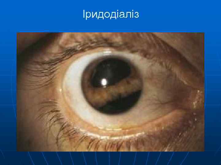 Іридодіаліз 