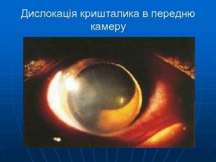 Дислокація кришталика в передню камеру 