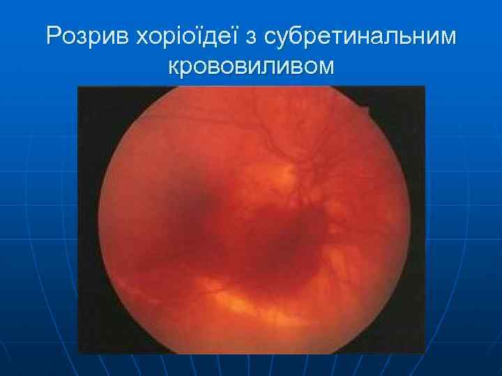Розрив хоріоїдеї з субретинальним крововиливом 