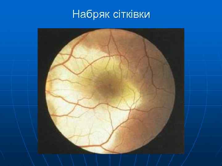 Набряк сітківки 