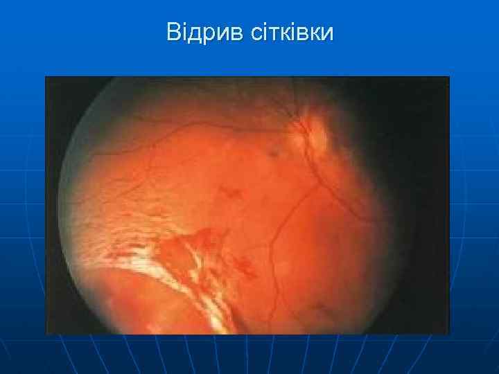 Відрив сітківки 