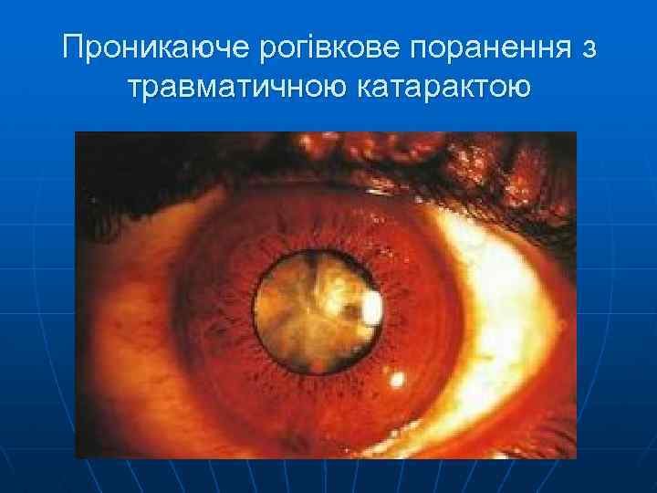 Проникаюче рогівкове поранення з травматичною катарактою 
