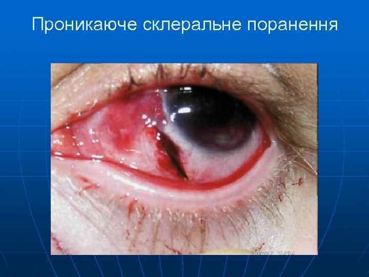 Проникаюче склеральне поранення 