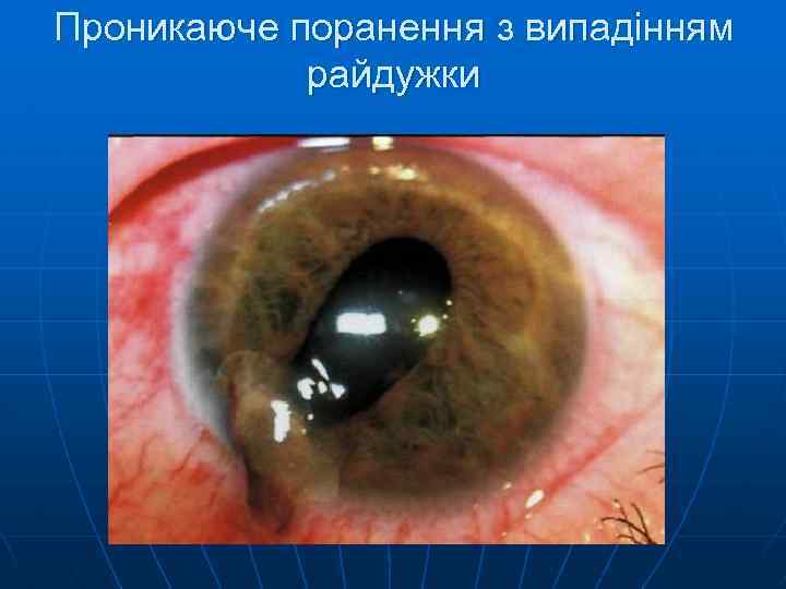 Проникаюче поранення з випадінням райдужки 