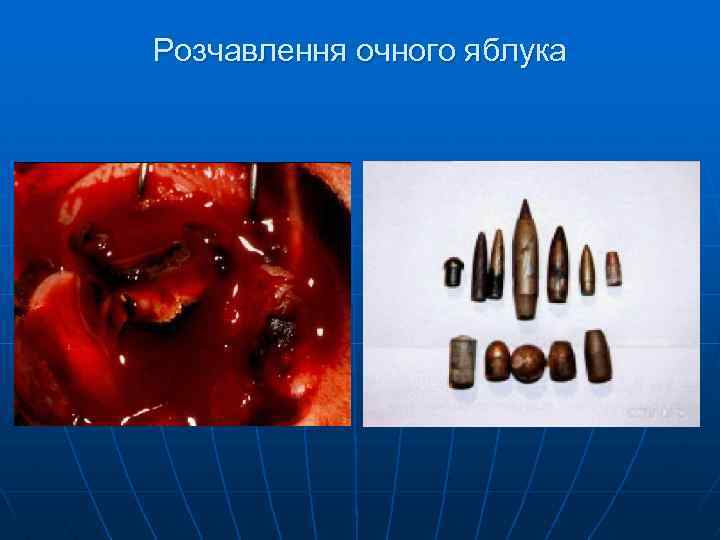 Розчавлення очного яблука 