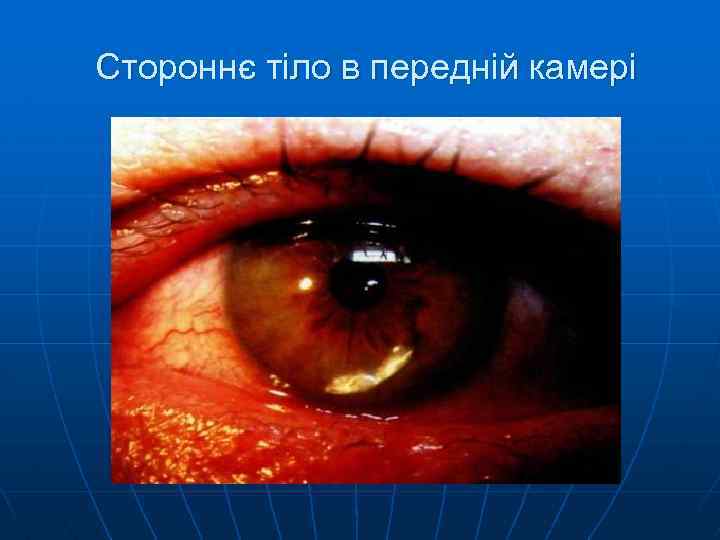 Стороннє тіло в передній камері 