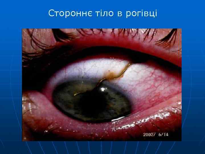 Стороннє тіло в рогівці 