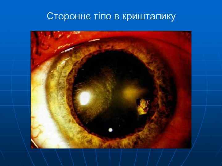 Стороннє тіло в кришталику 
