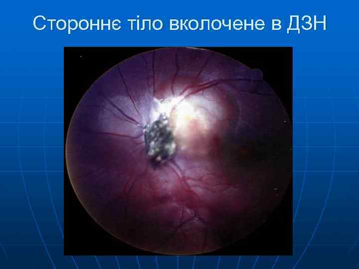 Стороннє тіло вколочене в ДЗН 