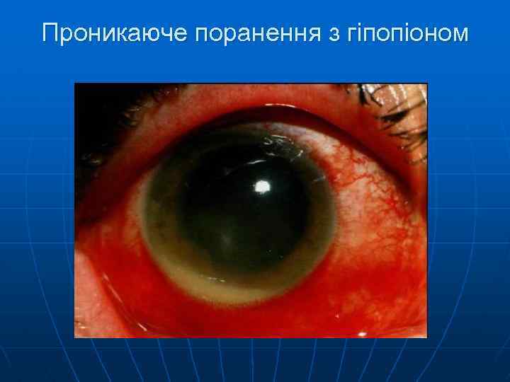 Проникаюче поранення з гіпопіоном 