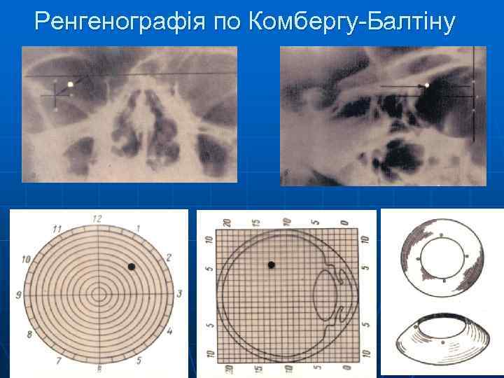 Ренгенографія по Комбергу-Балтіну 