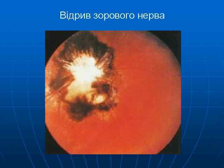 Відрив зорового нерва 