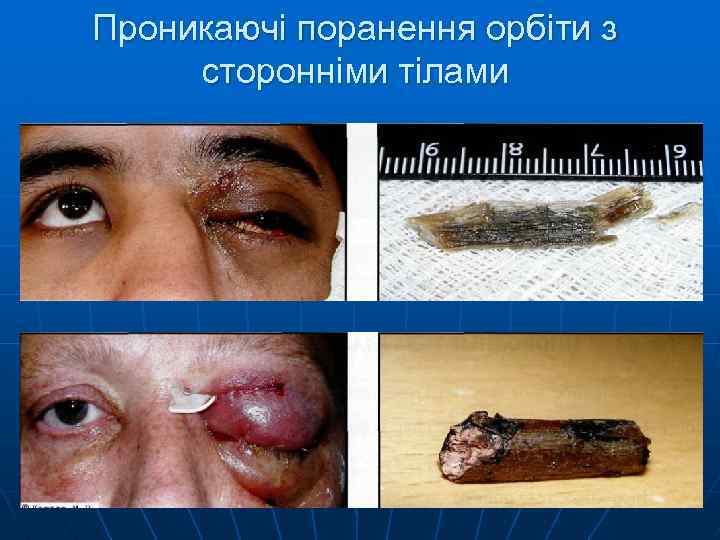 Проникаючі поранення орбіти з сторонніми тілами 