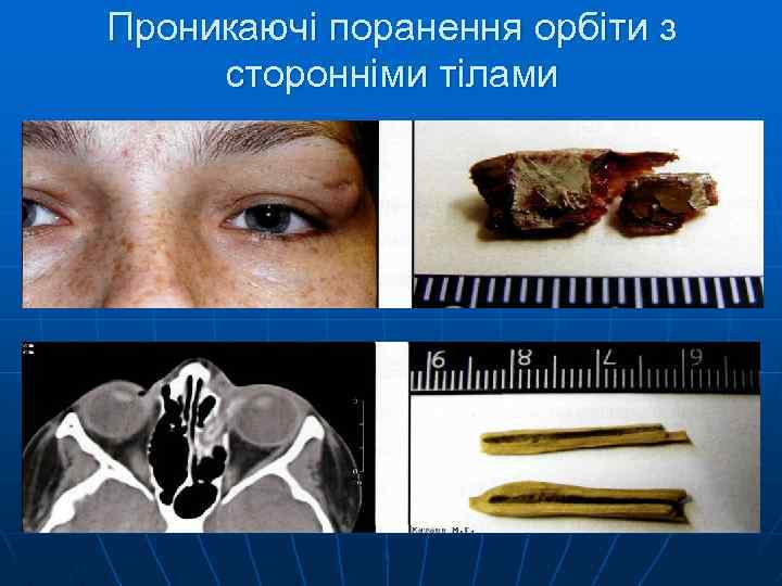 Проникаючі поранення орбіти з сторонніми тілами 