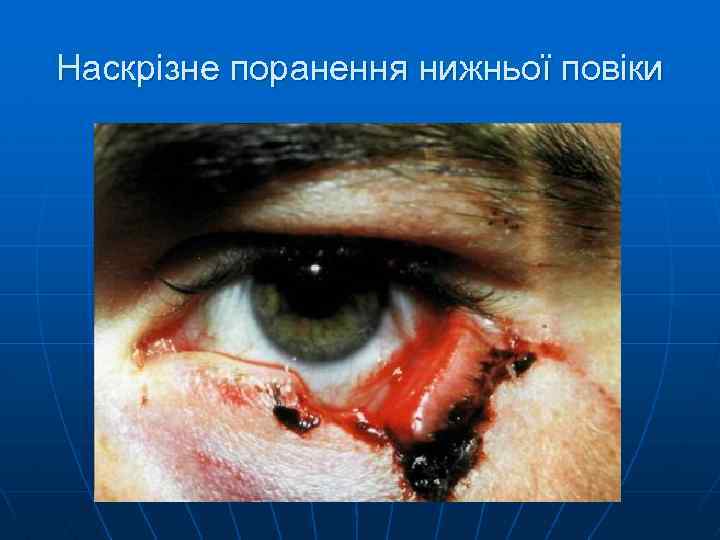 Наскрізне поранення нижньої повіки 