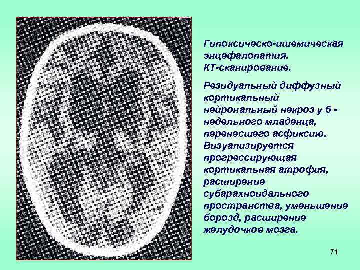 Гипоксически ишемическое поражение ЦНС кт. Кортикальный некроз кт. Кортикальный ламинарный некроз. Гипоксически-ишемическое поражение головного мозга кт.