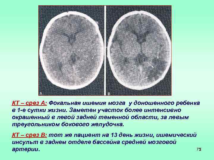 КТ – срез А: Фокальная ишемия мозга у доношенного ребенка в 1 -е сутки