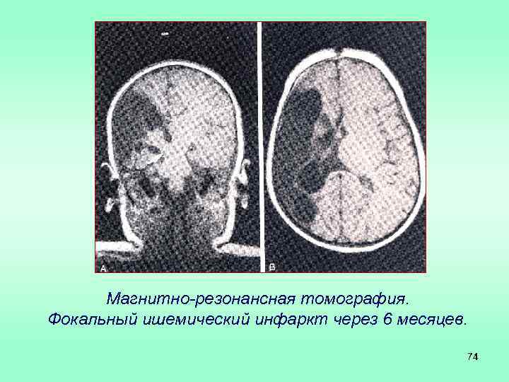 Магнитно-резонансная томография. Фокальный ишемический инфаркт через 6 месяцев. 74 