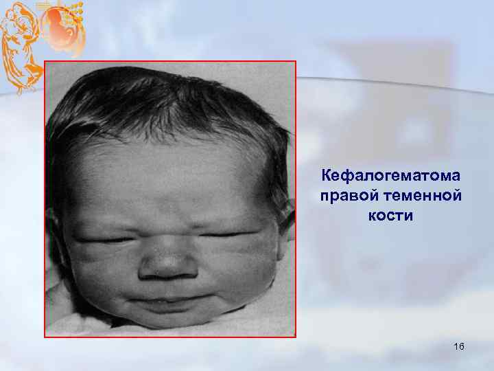 Кефалогематома правой теменной кости 16 