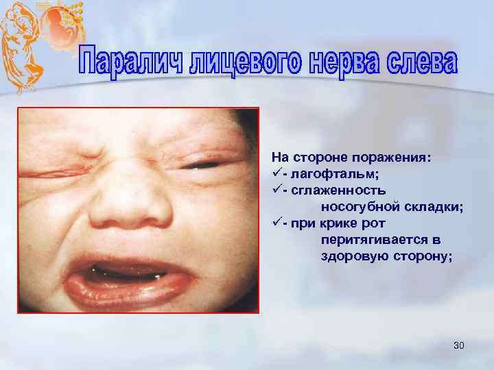 На стороне поражения: ü- лагофтальм; ü- сглаженность носогубной складки; ü- при крике рот перитягивается