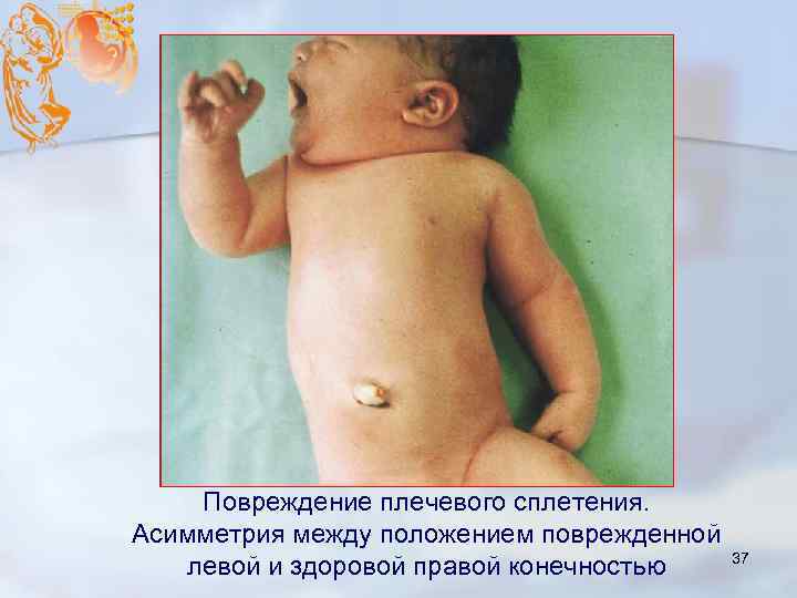 Повреждение плечевого сплетения. Асимметрия между положением поврежденной левой и здоровой правой конечностью 37 