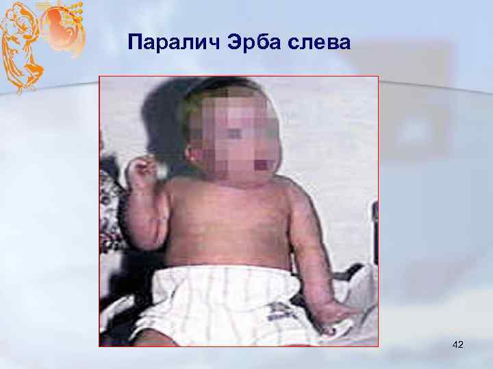 Паралич Эрба слева 42 