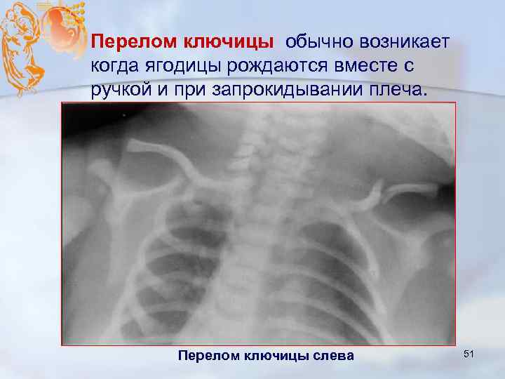 Перелом ключицы обычно возникает когда ягодицы рождаются вместе с ручкой и при запрокидывании плеча.