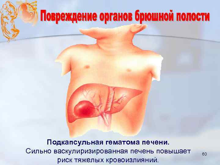 Подкапсульная гематома печени. Сильно васкулиризированная печень повышает риск тяжелых кровоизлияний. 60 