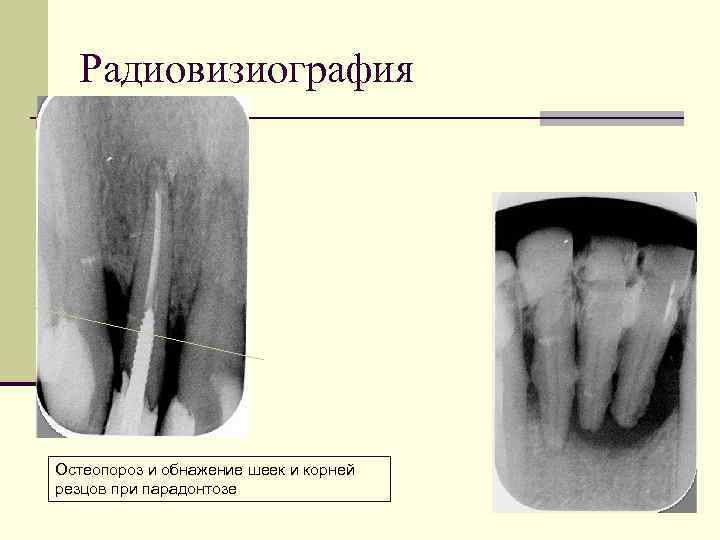 Радиовизиография Остеопороз и обнажение шеек и корней резцов при парадонтозе 