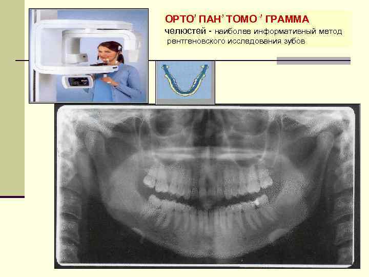 ОРТО ۥ ПАН ۥ ТОМО ۥ ГРАММА челюстей наиболее информативный метод рентгеновского исследования зубов