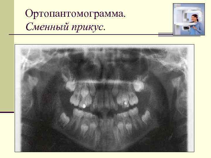 Ортопантомограмма. Сменный прикус. 