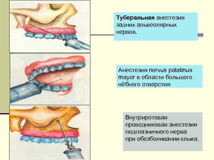 Туберальная анестезия задних альвеолярных нервов. Анестезия nervus palatinus mayor в области большого нёбного отверстия