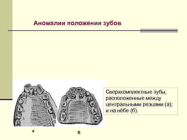 Аномалии положения зубов Сверхкомплектные зубы, расположенные между центральными резцами (а); и на нёбе (б).