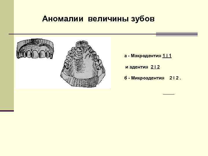 Аномалии величины зубов а - Макродентия 1 І 1 и адентия 2 І 2