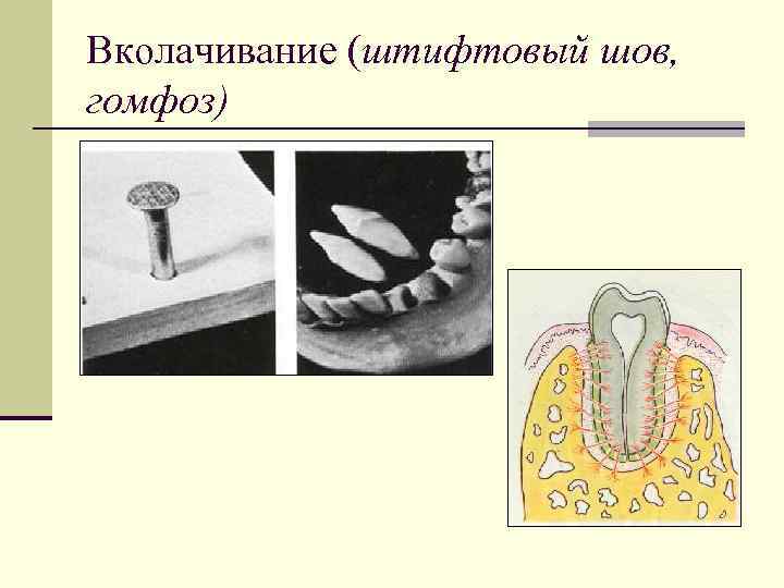 Вколачивание (штифтовый шов, гомфоз) 