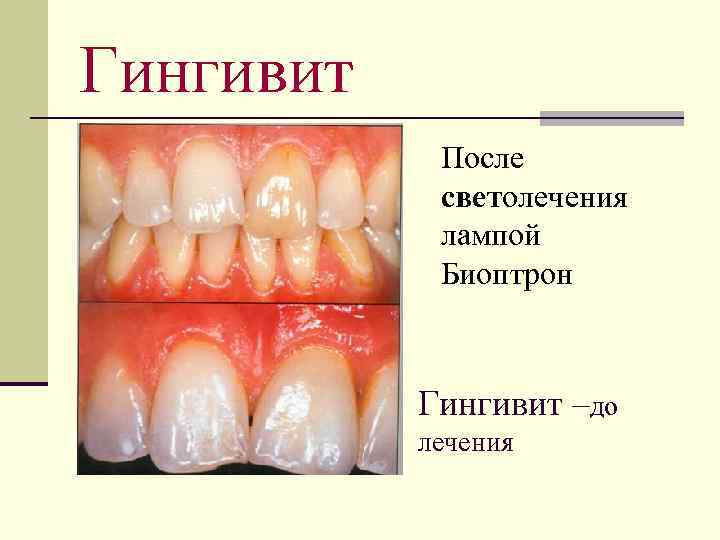 Гингивит После светолечения лампой Биоптрон Гингивит –до лечения 