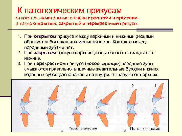 К патологическим прикусам относятся значительные степени прогнатии и прогении, а также открытый, закрытый и