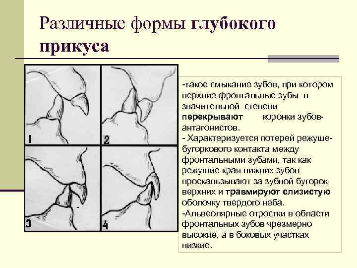 Различные формы глубокого прикуса такое смыкание зубов, при котором верхние фронтальные зубы в значительной