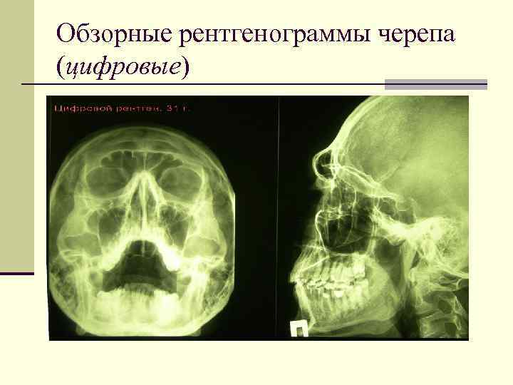 Обзорные рентгенограммы черепа (цифровые) 