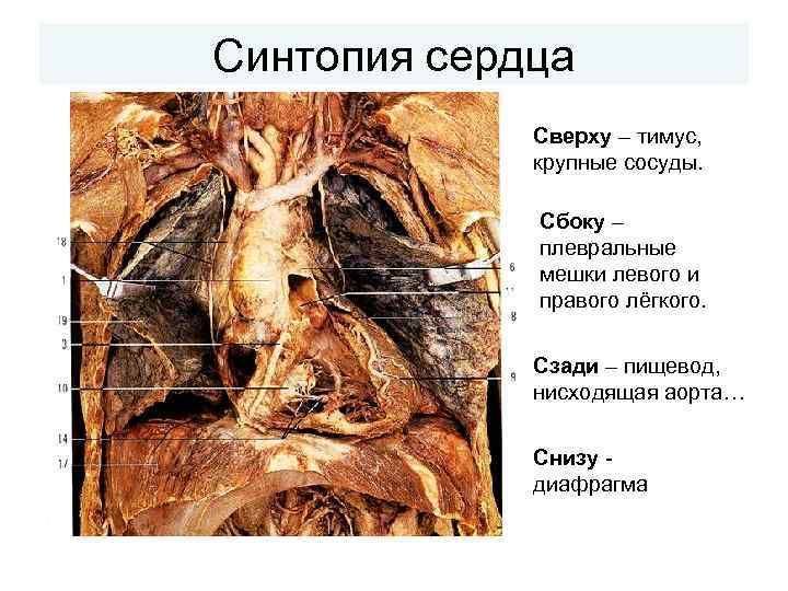 Синтопия сердца Сверху – тимус, крупные сосуды. Сбоку – плевральные мешки левого и правого